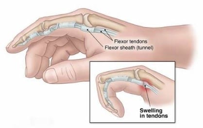 What is a Trigger Finger?: Orthopaedic Associates