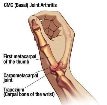 basal thumb arthritis treatment