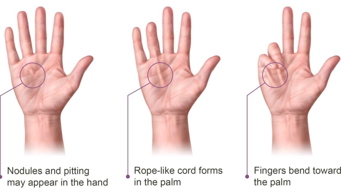 Dupuytrens Contracture Md West One