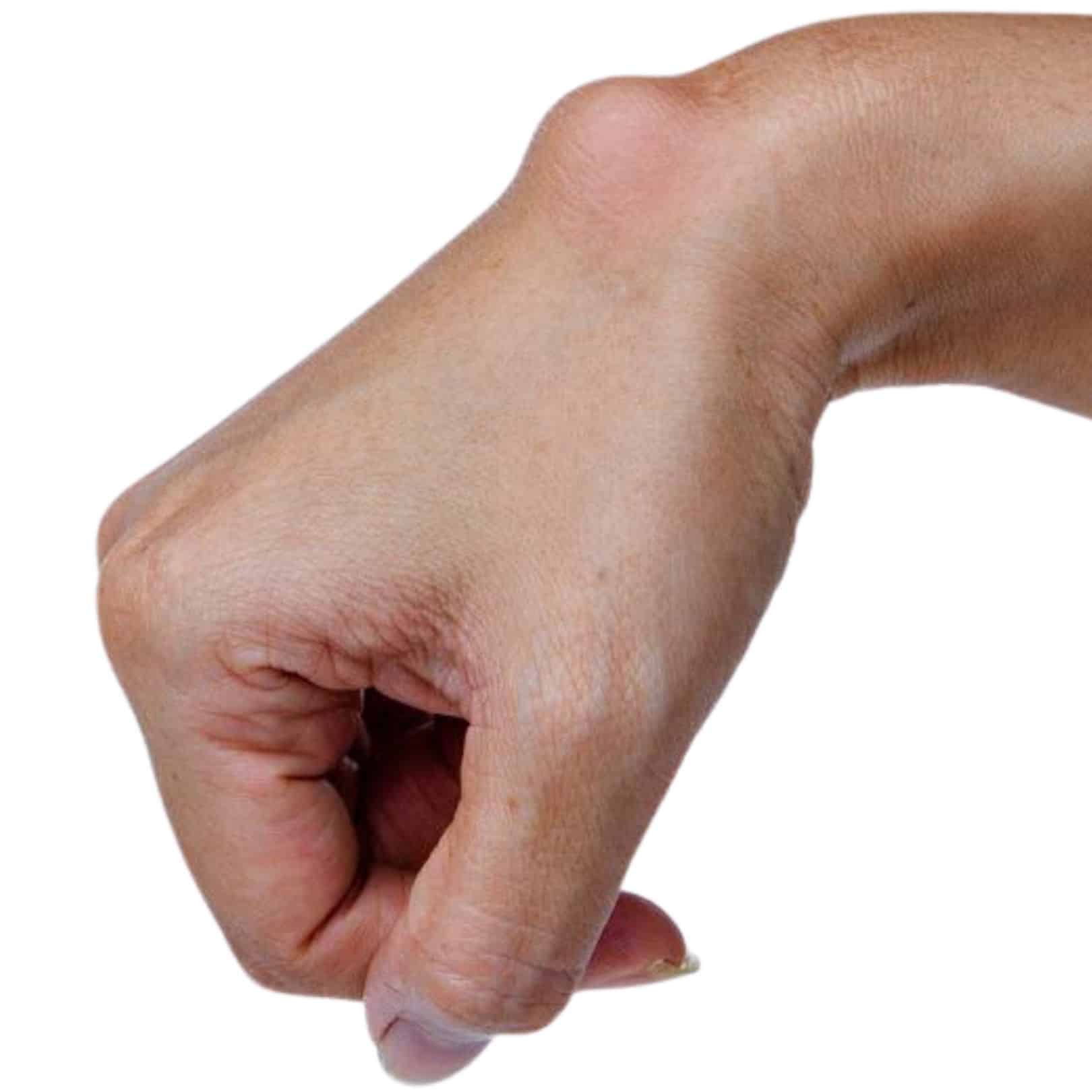 What to Do If You Have a Ganglion Cyst