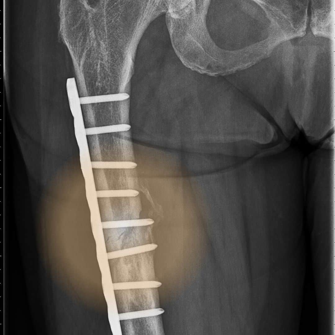 Internal Fixation