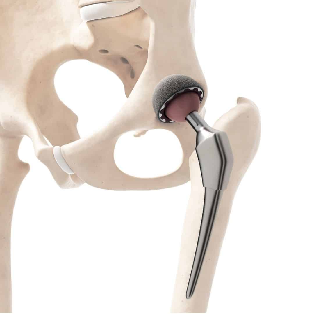 Total hip replacement