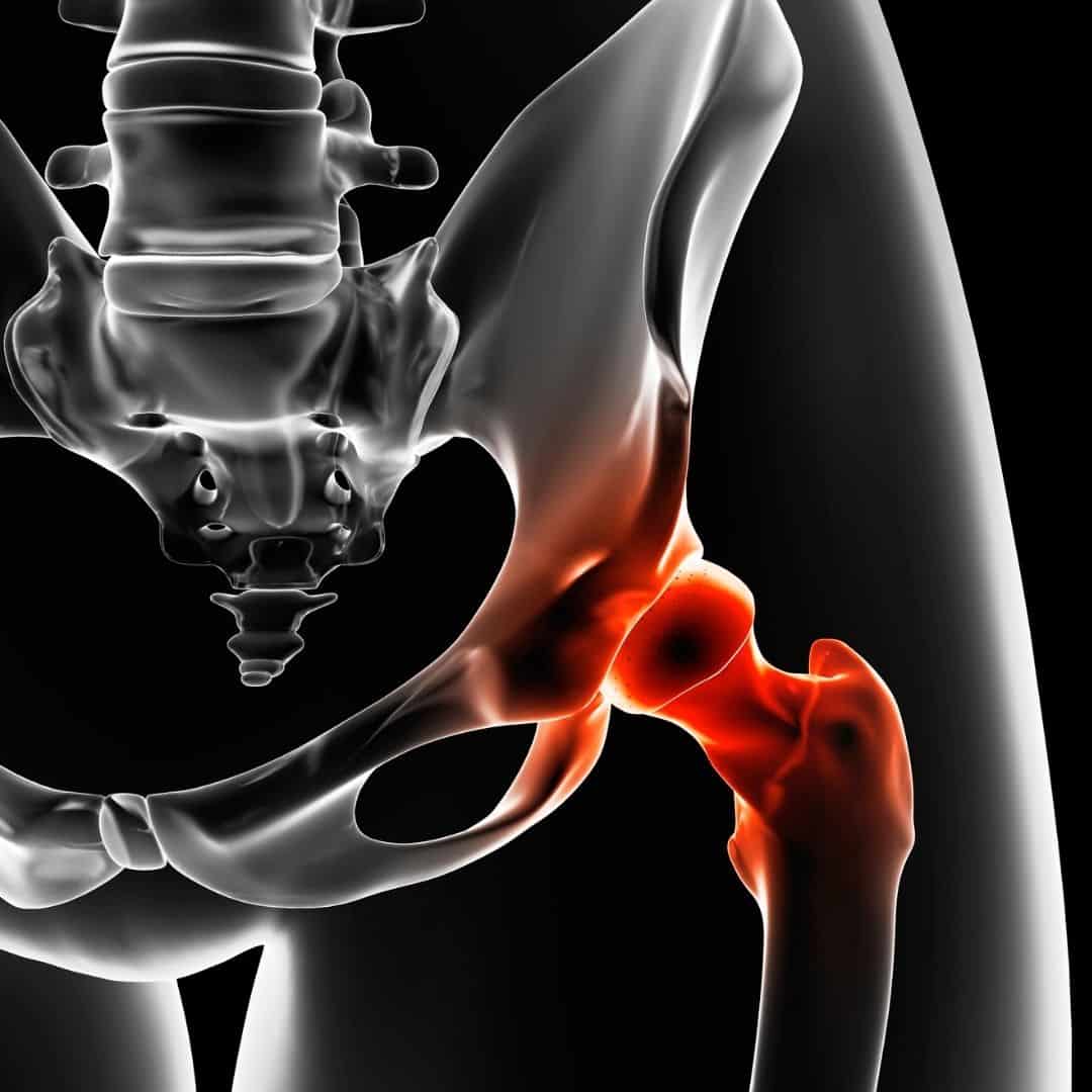 anterior hip replacement precautions