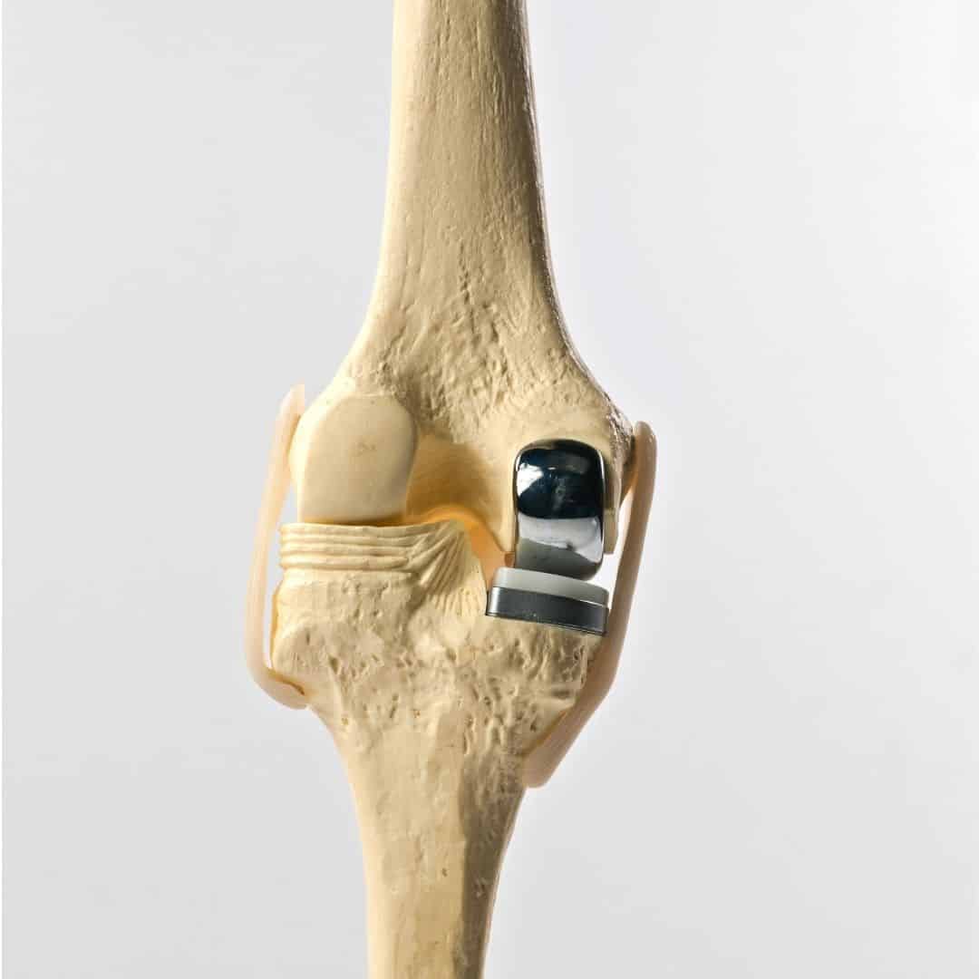 Minimally Invasive Partial Knee Replacement Surgery