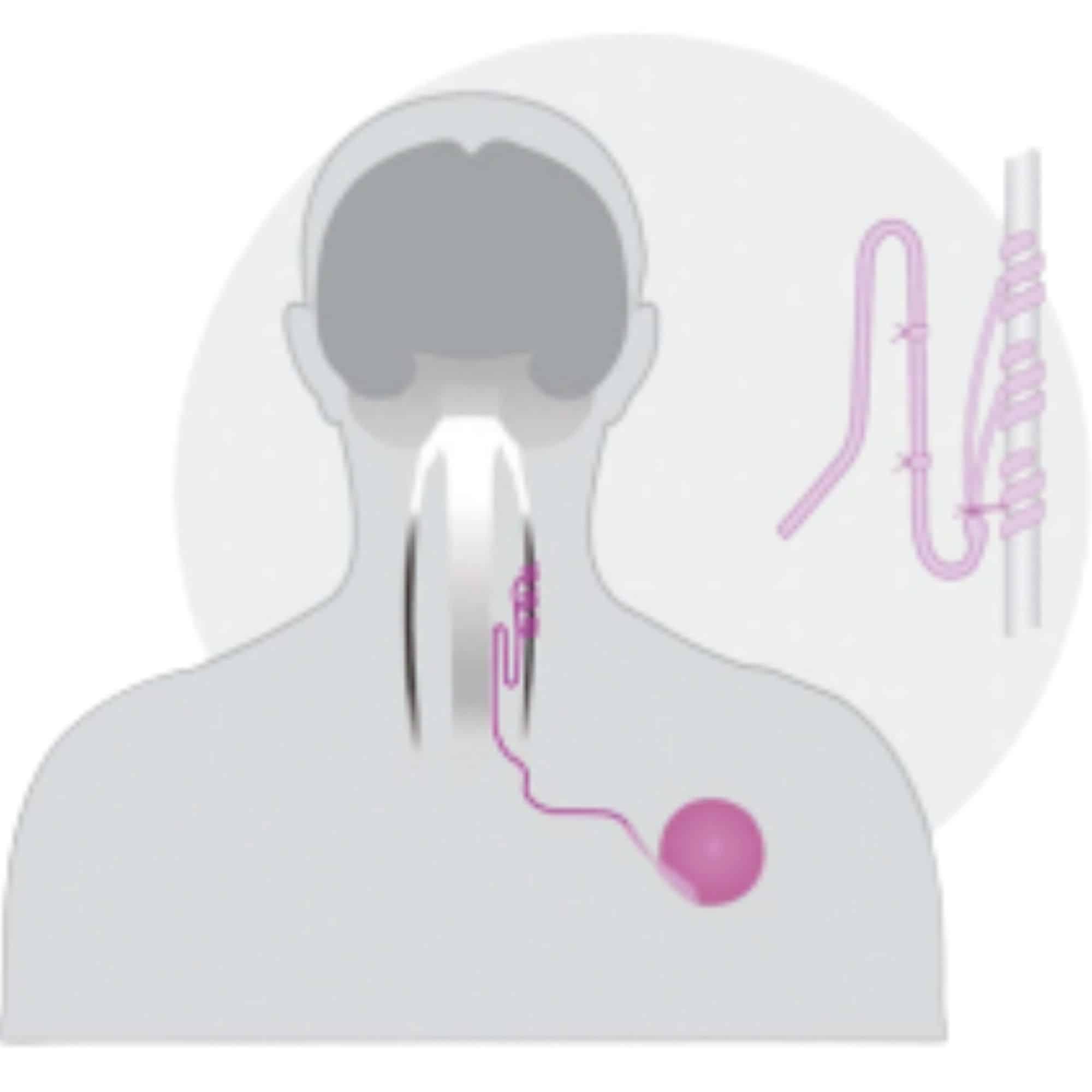 The vagus nerve-stimulation device used for implantation, obtained