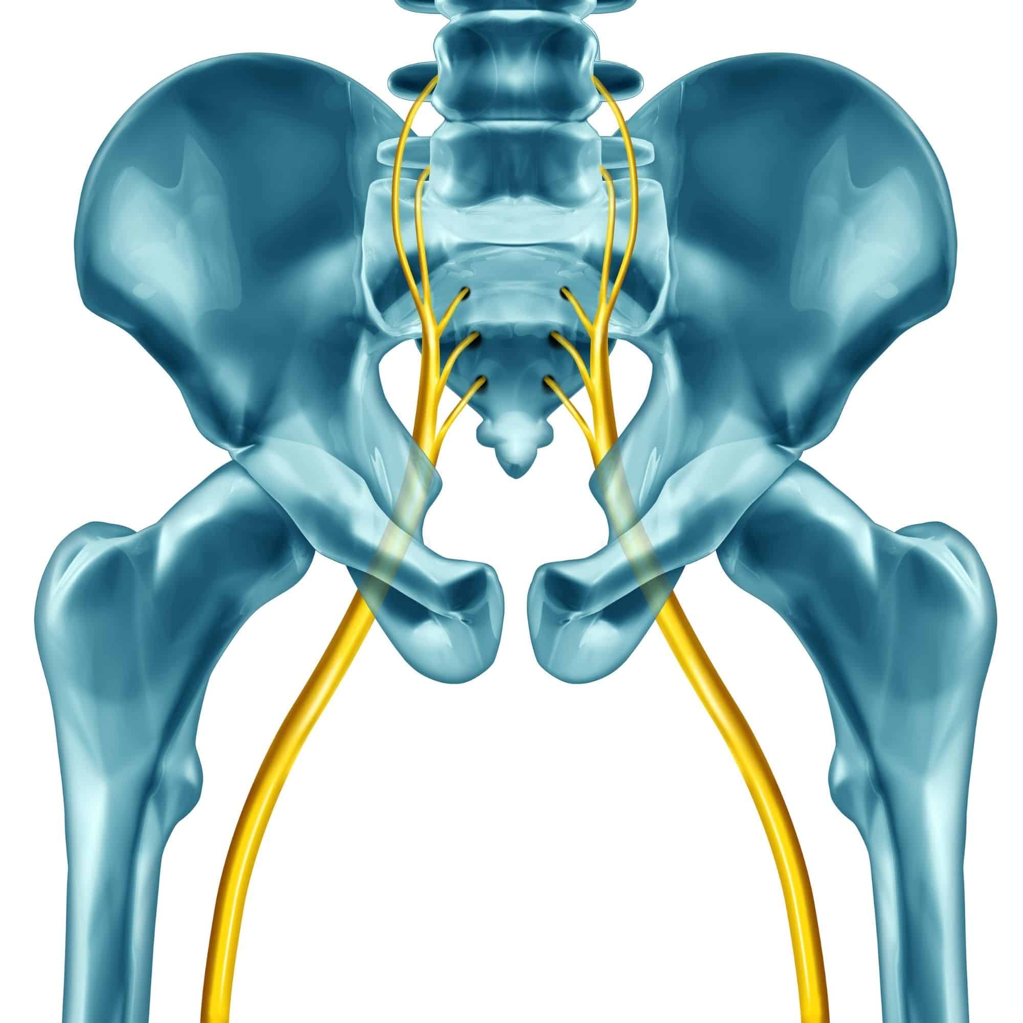 Sciatic (Lumbar) Pain