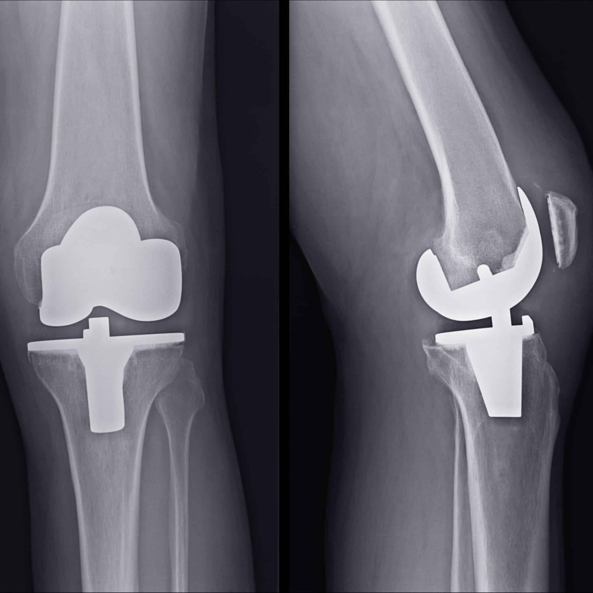 bilateral knee replacement