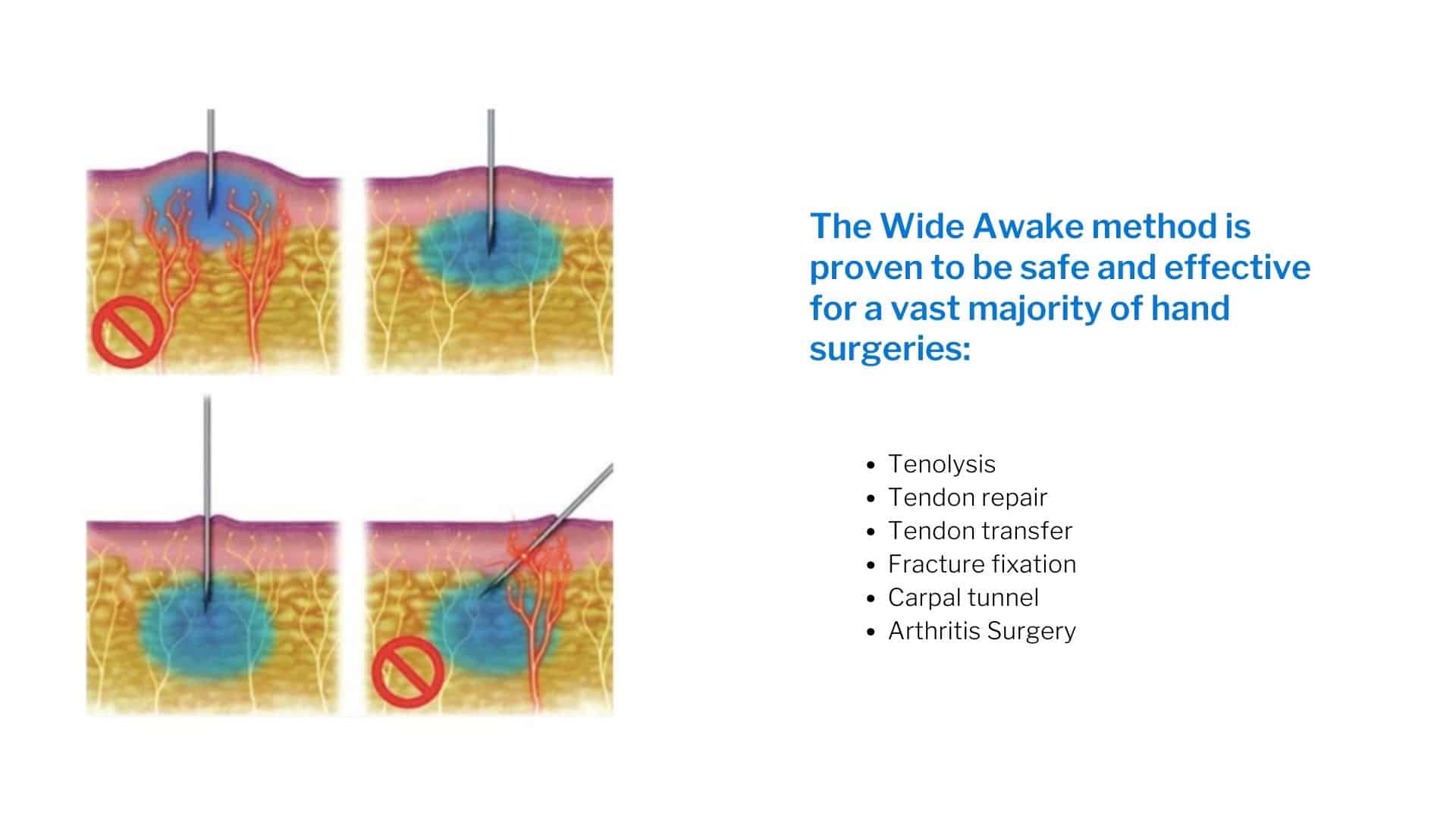 Wide Awake Hand Surgery Treatments