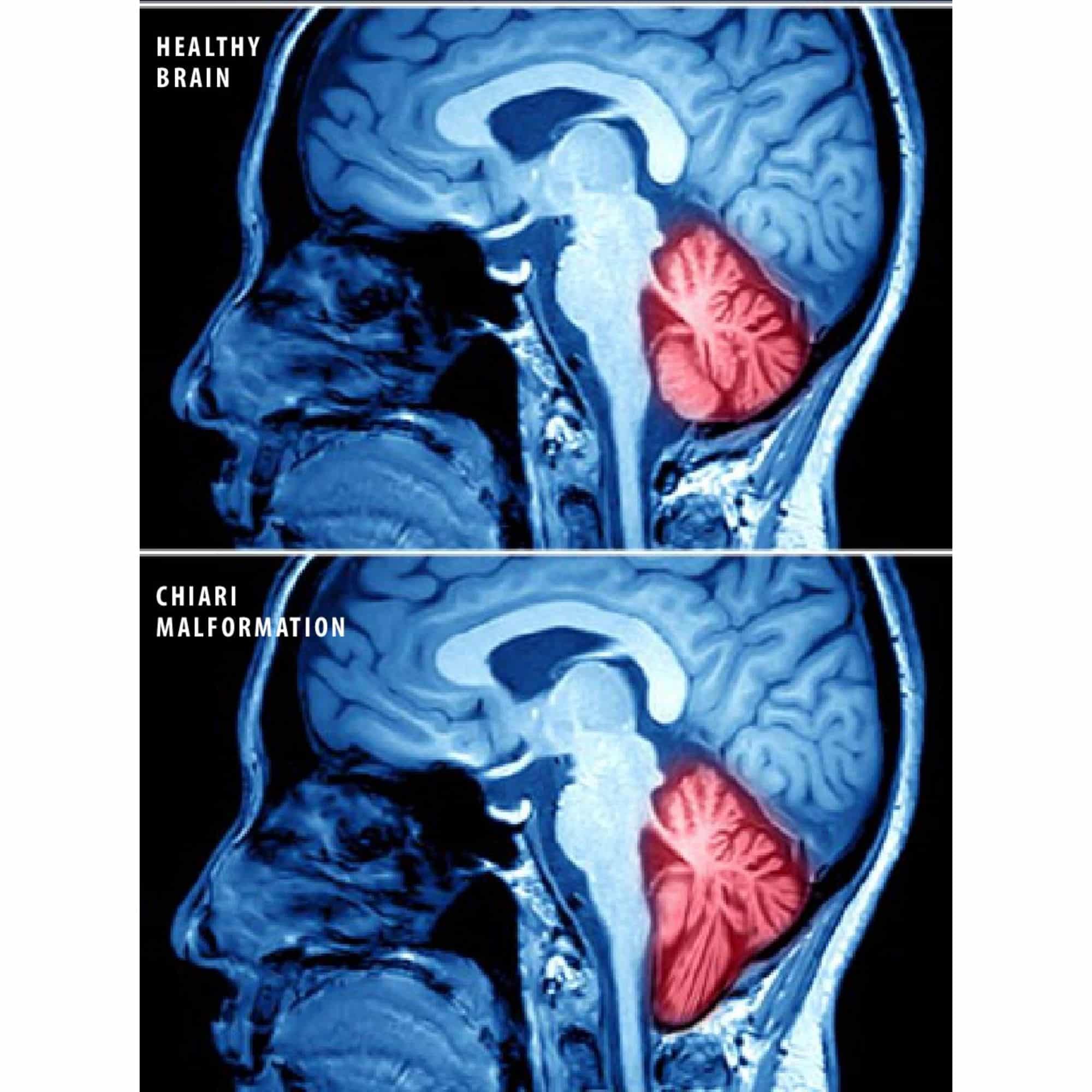 Chiari Malformation