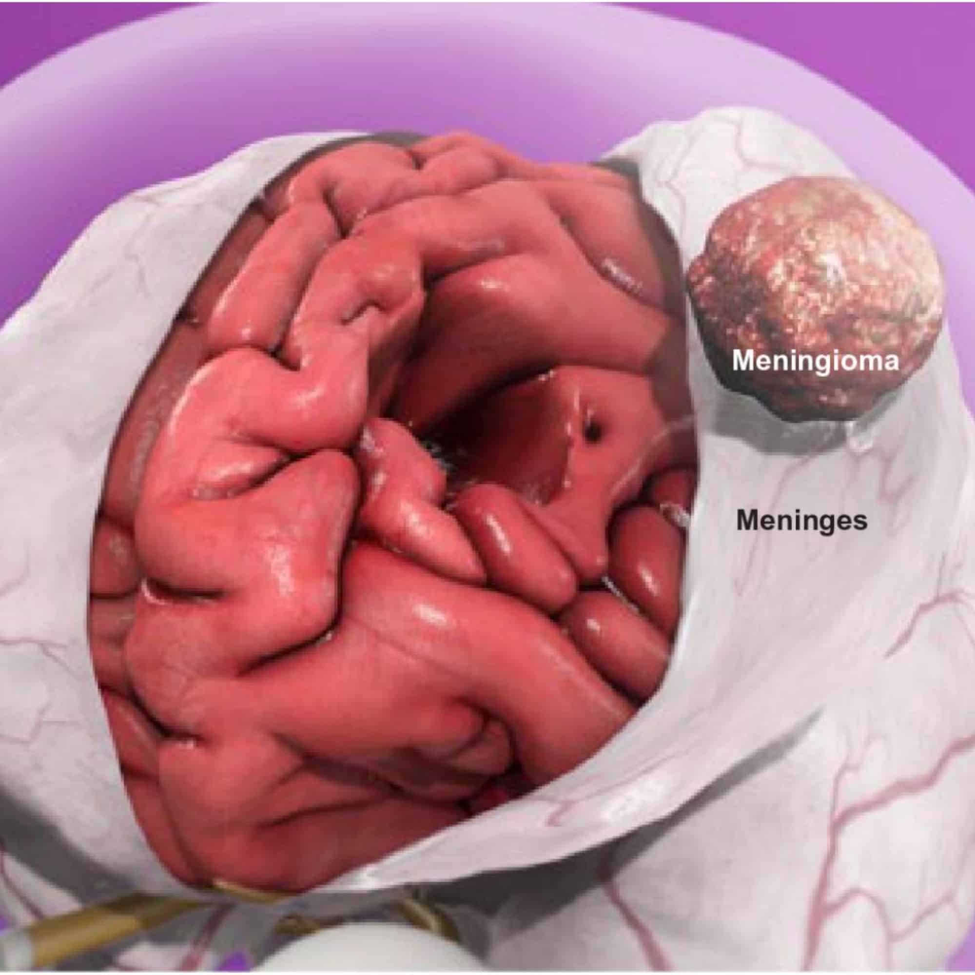 Meningioma