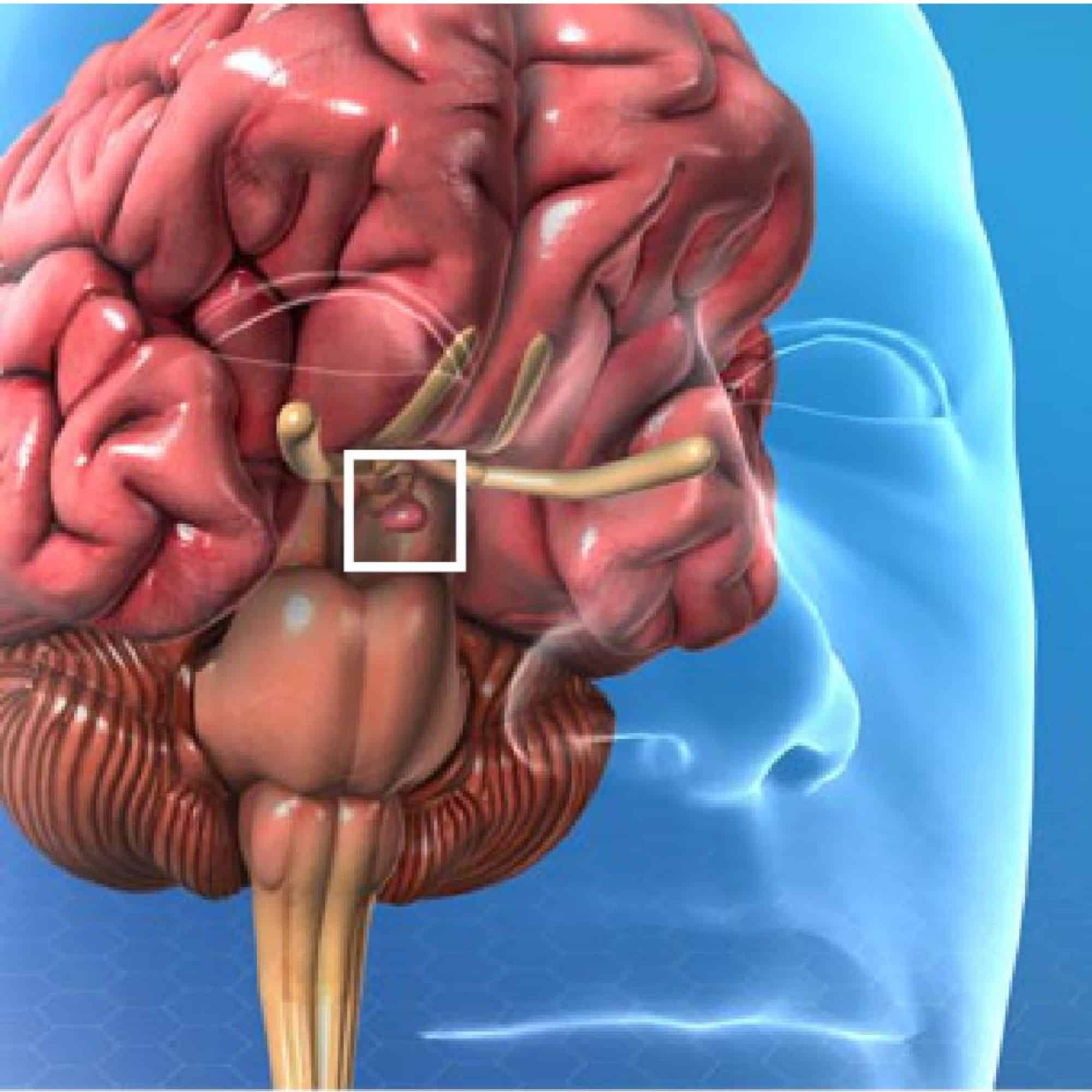 Pituitary Adenoma Tumor