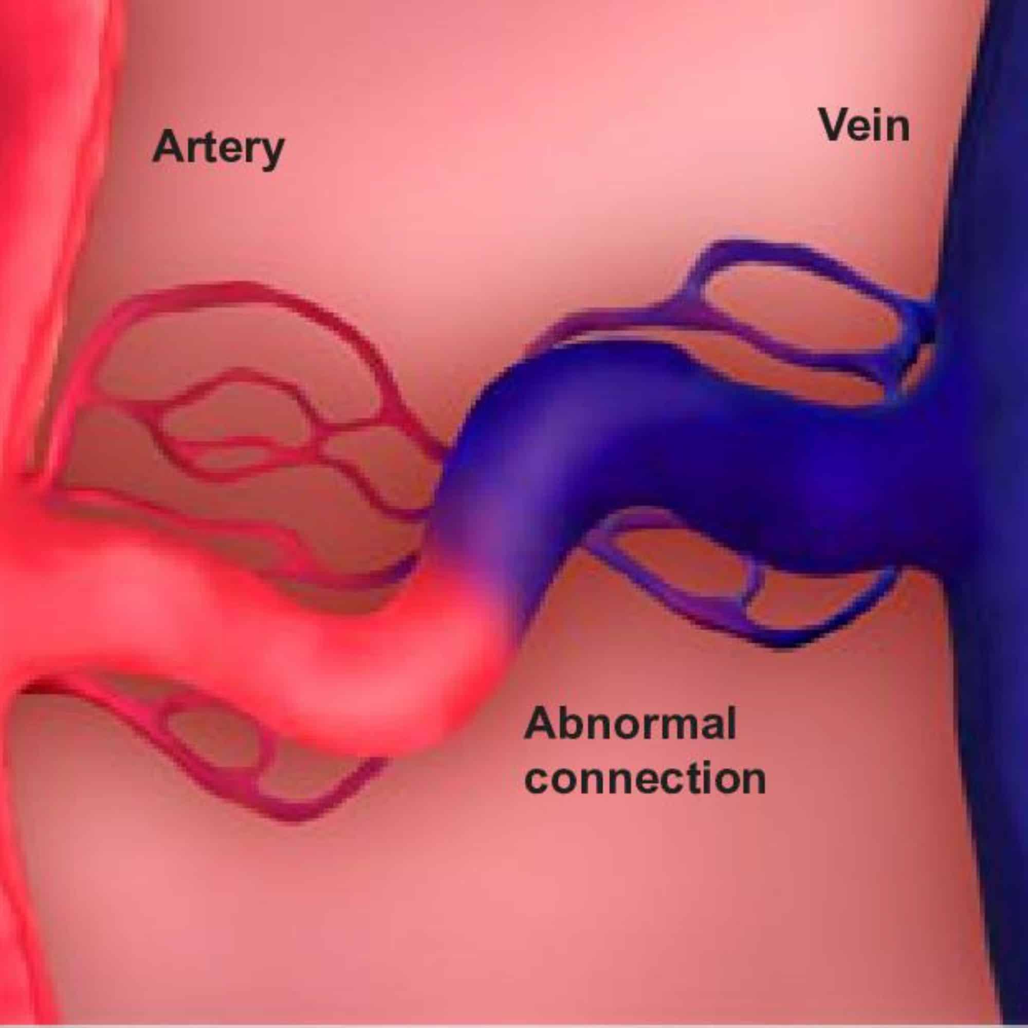 Arteriovenous Malformation (AVM)