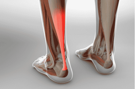 Approximate Recovery Time for an Achilles Tendon Injury