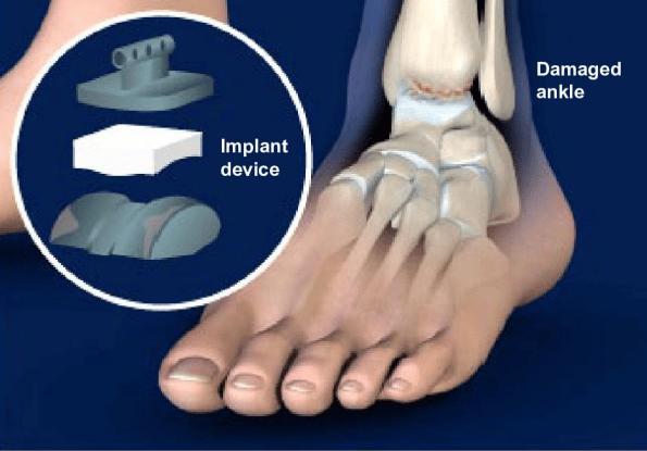 ankle-replacement
